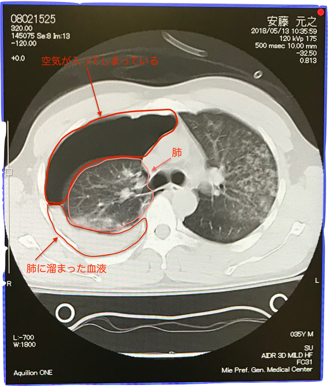 肺挫傷のMRI画像